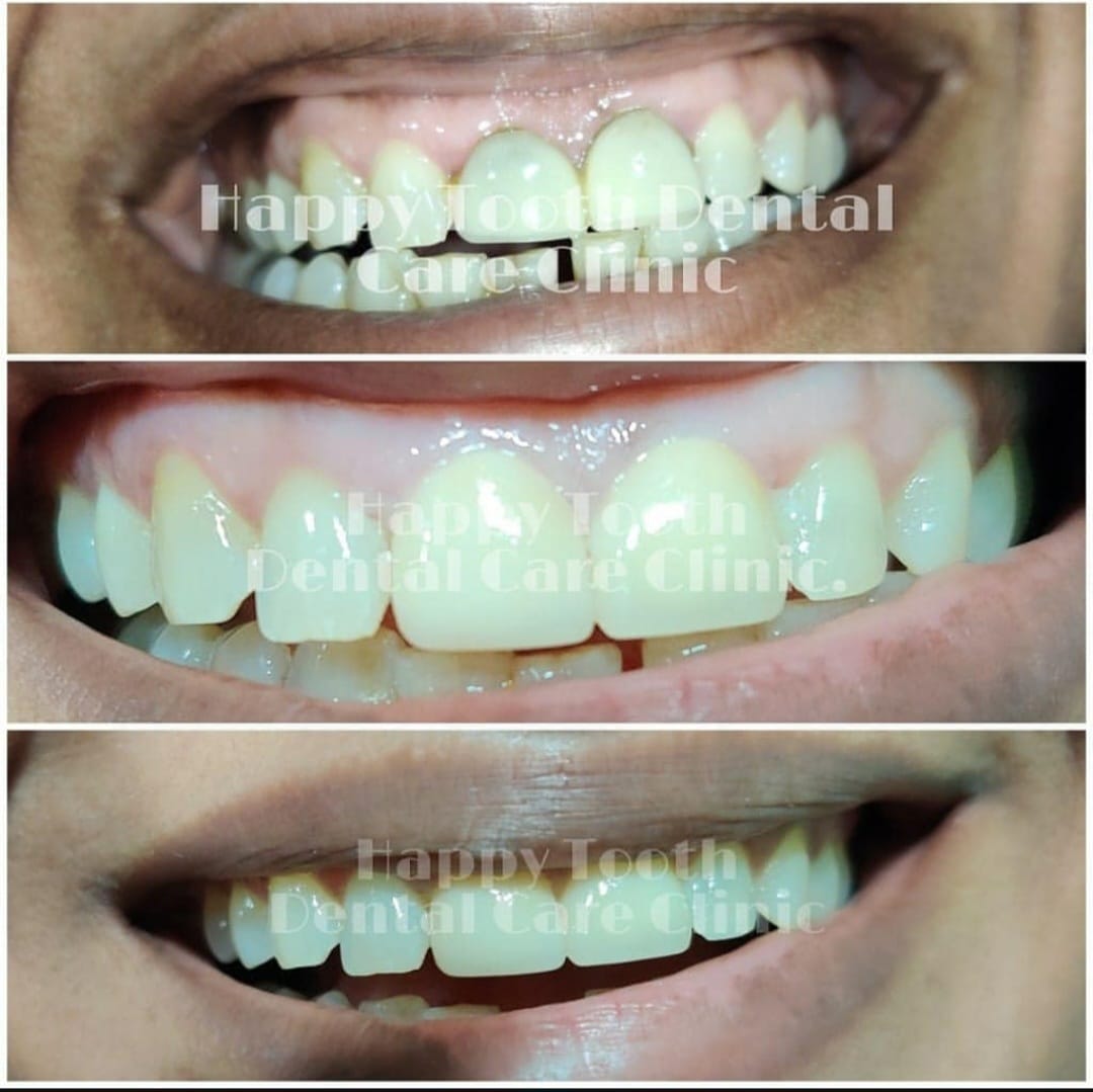 Before and after dental treatment result at Dr Santosh Nayak's dental clinic in Mahim