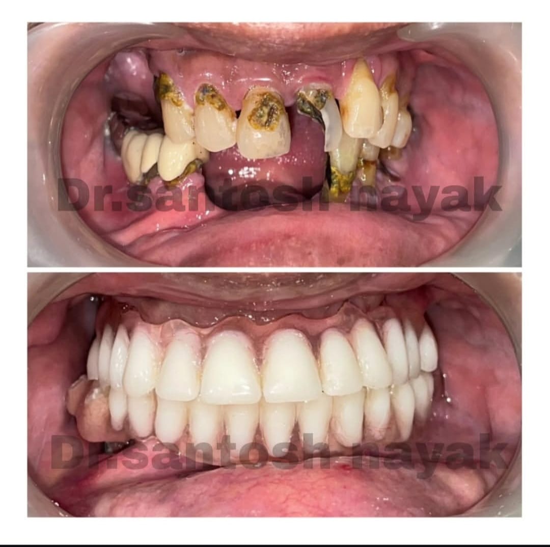 Before and after dental treatment result at Dr Santosh Nayak's dental clinic in Mahim